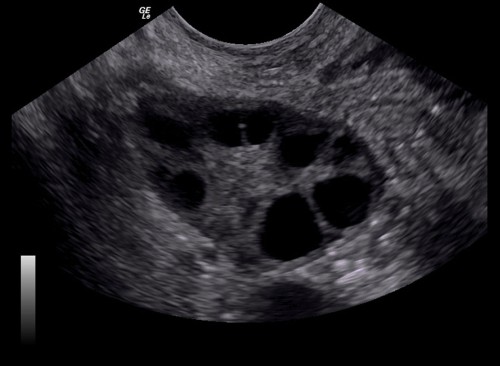 Fertility Investigations Ultrasound