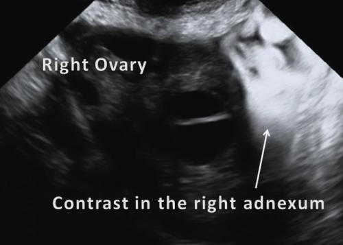 Fertility Investigations HyCoSy